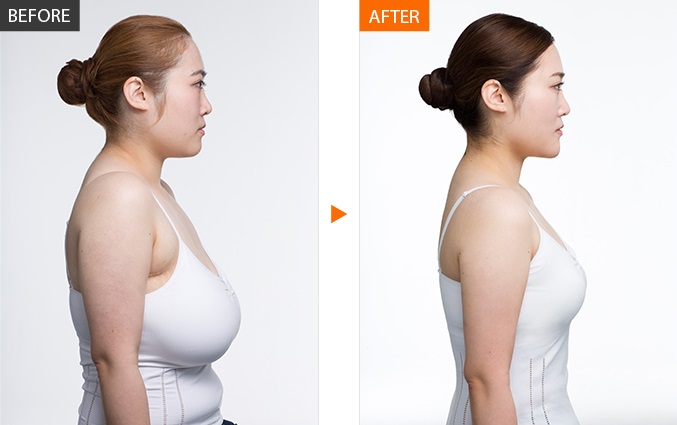 Breast Reduction before after