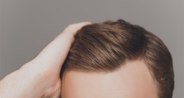 How To Cover Hair Transplant Scar