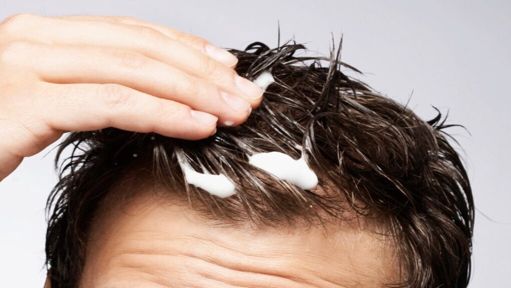 What are the side effects of Minoxidil