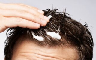 What are the side effects of Minoxidil