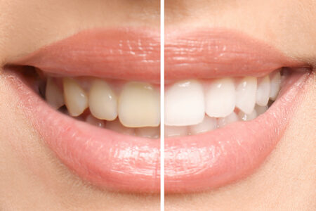 How teeth whitening kits work