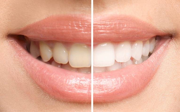 How teeth whitening kits work