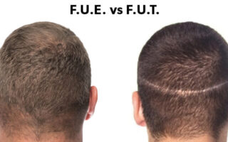 FUE vs. FUT Which Is the Better Hair Transplant Method