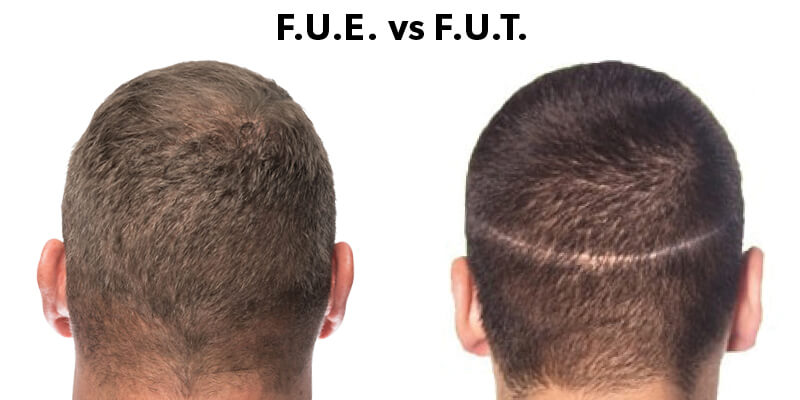FUE vs. FUT Which Is the Better Hair Transplant Method