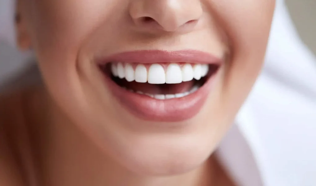 How Do You Keep Your Teeth Clean Under Veneers