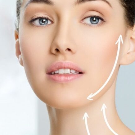 What is Endolift technology