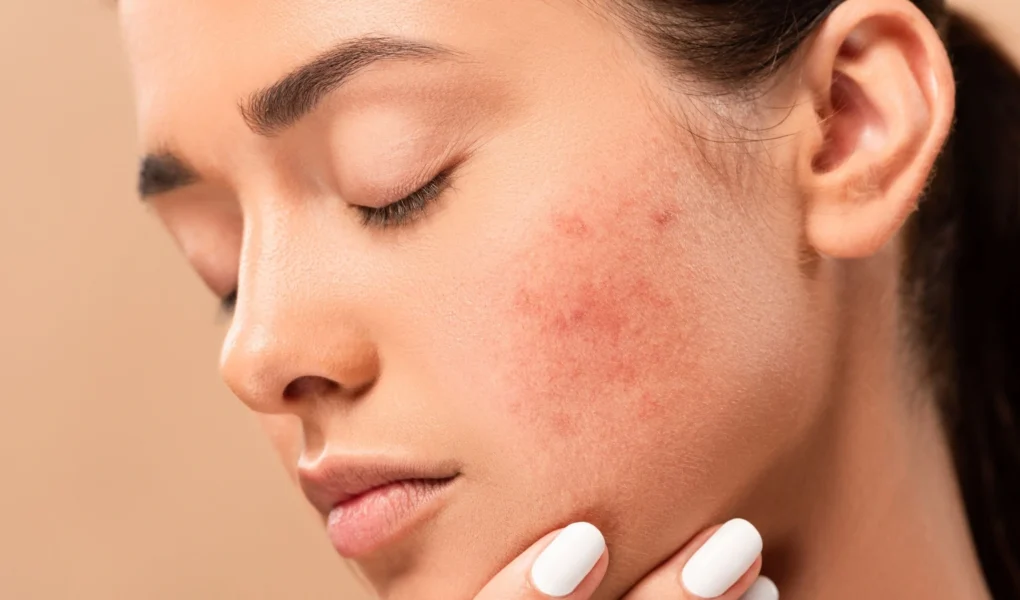 Are there foods that cause hormonal acne