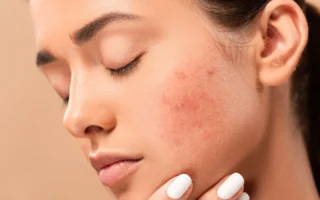 Are there foods that cause hormonal acne