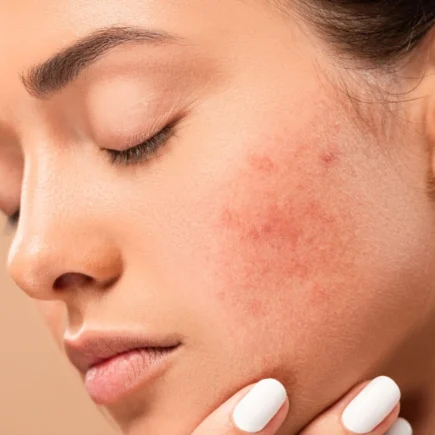 Are there foods that cause hormonal acne