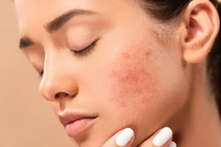 Are there foods that cause hormonal acne
