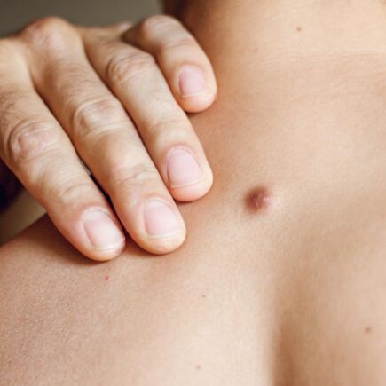 I Have A Skin Tag Will It Go Away