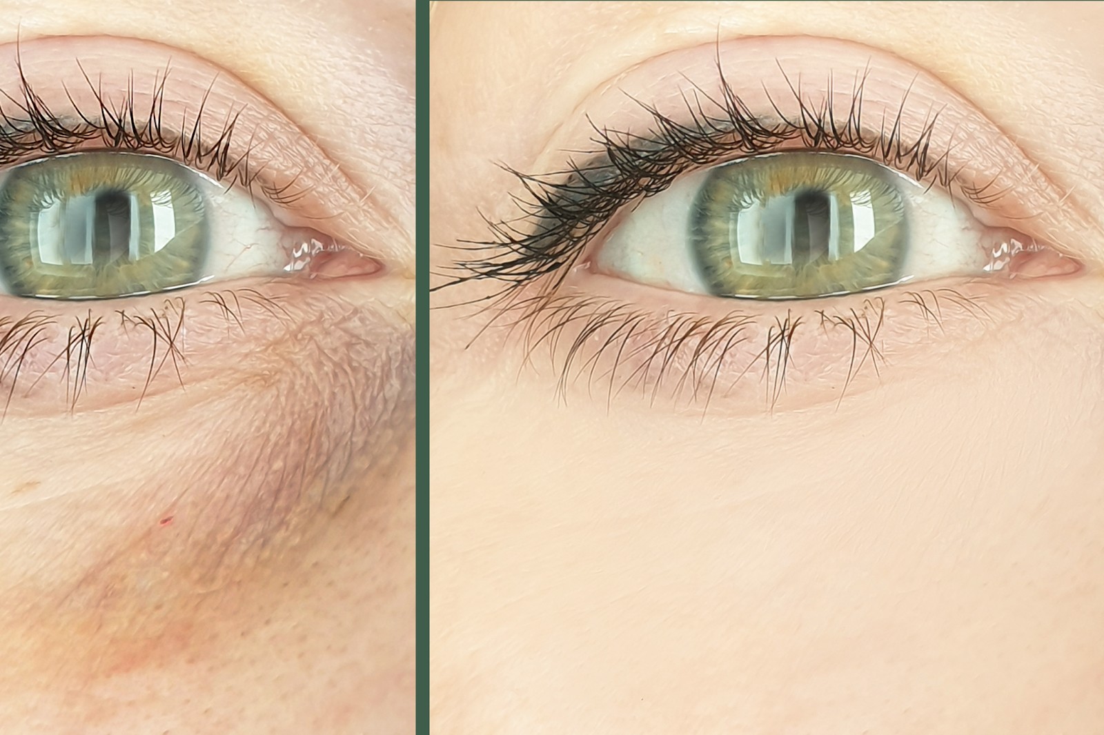How Long Does Under Eye Filler Last? The Mews Beauty