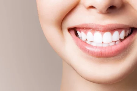 Teeth Whitening A Complete Guide