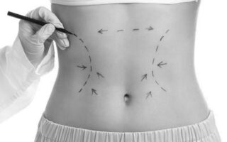 Body Contouring Methods