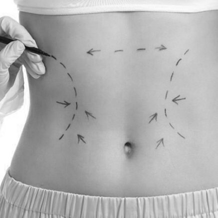 Body Contouring Methods