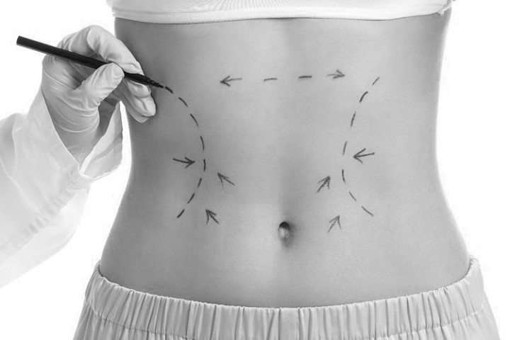 Body Contouring Methods